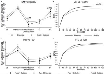 Simple Quantitative Sensory Testing Reveals Paradoxical Co-existence of Hypoesthesia and Hyperalgesia in Diabetes